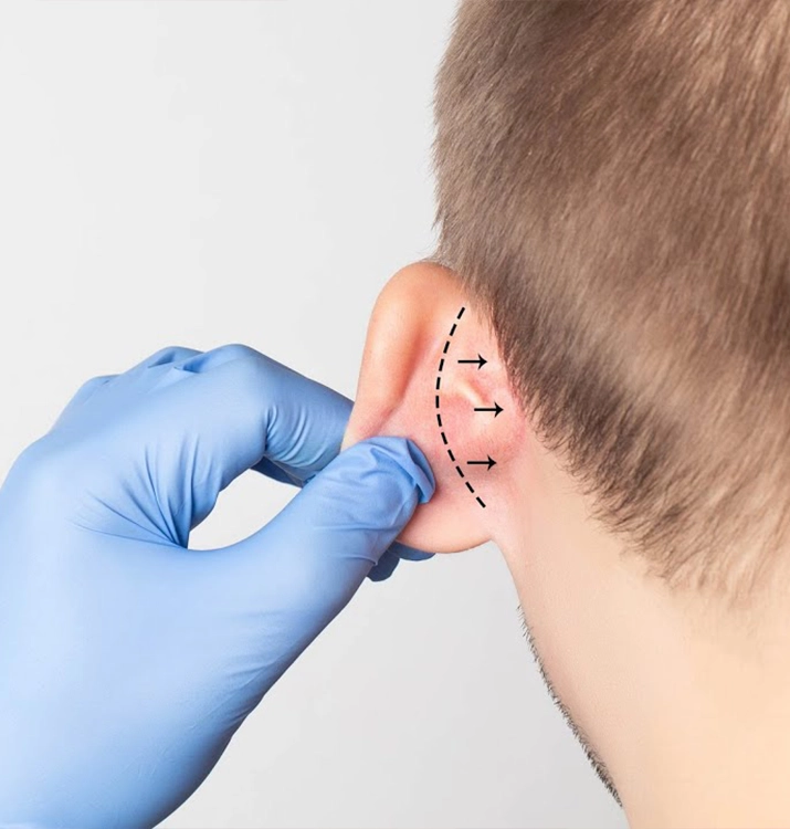 pegas medikal – flap-kulak estetiği